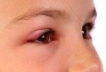 Bộ Y tế khuyến cáo phòng chống bệnh đau mắt đỏ
