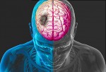 Hình ảnh tắc động mạch não giữa gây nhồi máu não ở bệnh nhân rung nhĩ.