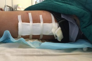 Bệnh nhân Bình có thể được xuất viện trong vài ngày tới