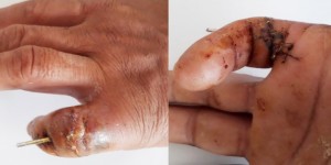 Phẫu thuật nối thành công cho bệnh nhân đứt gần lìa ngón tay