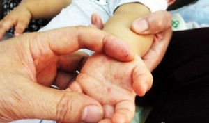 6 ca tử vong vì tay chân miệng, Bộ Y tế yêu cầu khẩn trương chống dịch