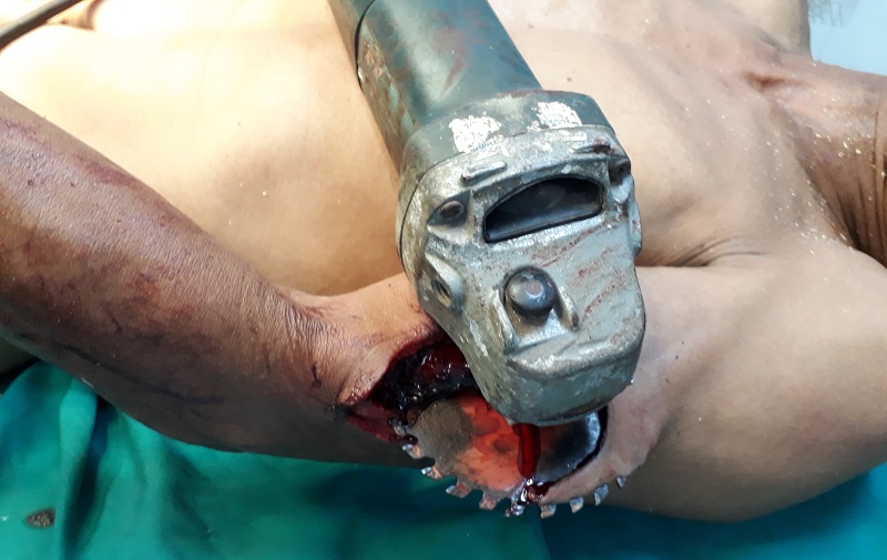 Bệnh viện Thạch Hà cấp cứu thành công bệnh nhân bị chấn thương nặng do lưỡi cưa cắm vào cánh tay trái