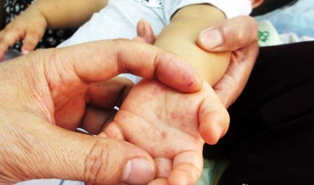 6 ca tử vong vì tay chân miệng, Bộ Y tế yêu cầu khẩn trương chống dịch