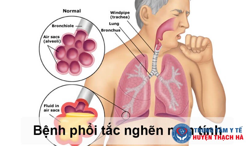 Trung tâm Y tế huyện Thạch Hà: Triển khai đơn nguyên quản lý Hen và Bệnh phổi tắc nghẽn mạn tính.
